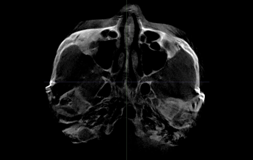 Is It Necessary to Remove the Fixation Pins After Facial Contouring Surgery? image 7