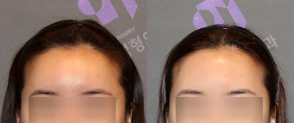 Forehead Fat Grafting Side Effects: Is There a Way to Remove Excess Fat? image 7