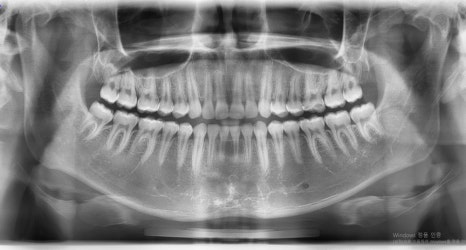 Which Surgery Do I Need: Contouring Surgery or Double-Jaw Surgery? image 11