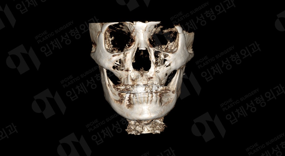 If the Face (Cheekbones) Is Asymmetrical, Can It Be Corrected with Cheekbone Reduction Surgery? image 1