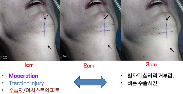 이중턱 근육묶기의 최소 절개와 해부학적 구조 관련 이미지 3