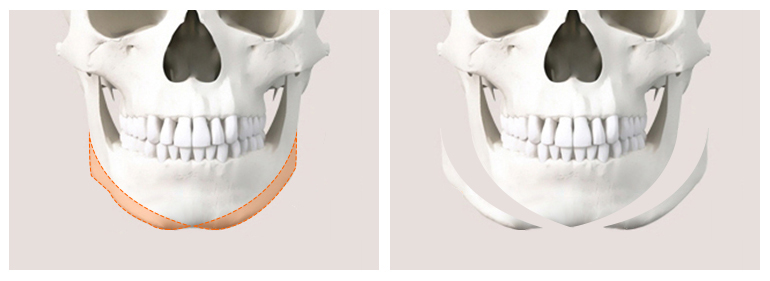 Why Are There So Many Different Chin Surgery Methods? Exploring Advancement, Setback, Reduction, and Lengthening image 3
