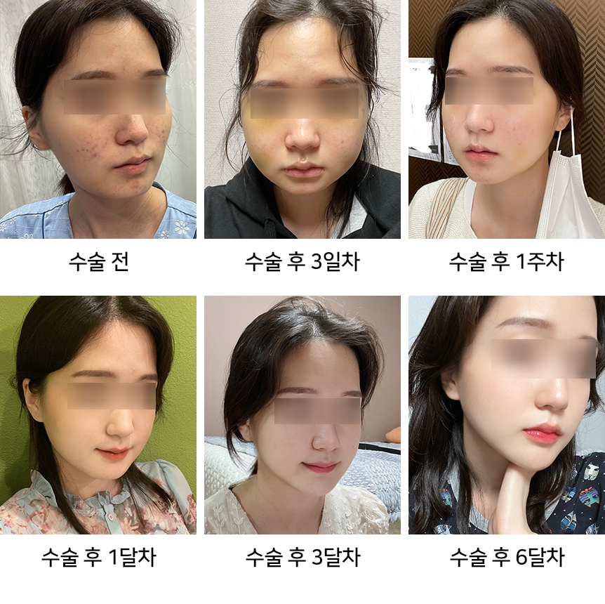 안면윤곽수술 후 회복은 왜 6개월이나 걸리는 건가요? 관련 이미지 1