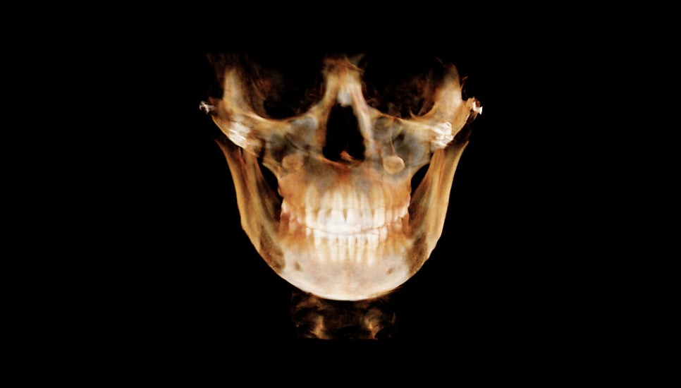 Why Is Male Cheekbone Reduction Different from Female Cheekbone Reduction? image 4
