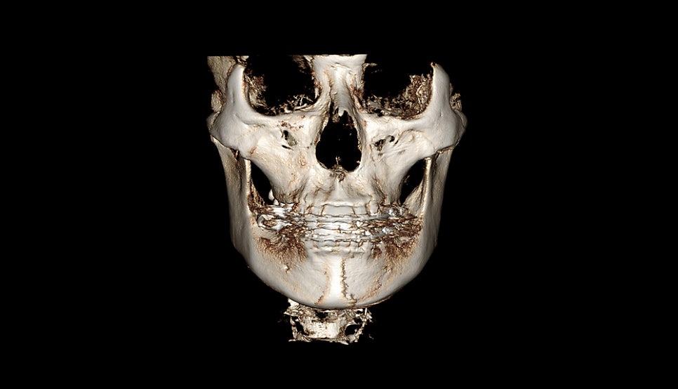 How Much Effect Does 230-Degree Three-Dimensional Zygomatic Reduction Have? image 7
