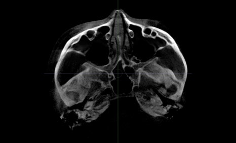 Consultation and Design Before Facial Contouring Surgery image 10