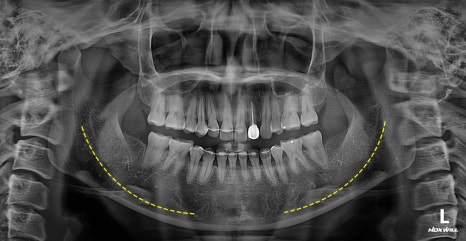 Does a Low Nerve Canal Make Square Jaw Surgery Difficult? Ways to Improve Frontal Results image 5