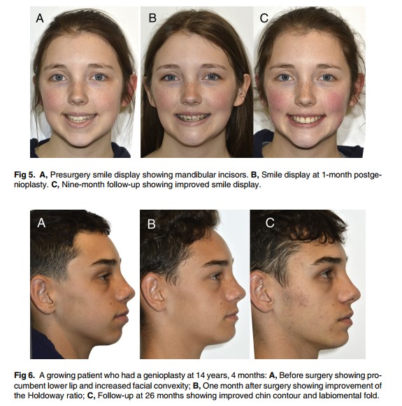 [Paper Review] The Relationship Between Forward Movement of the Chin Bone and Soft Tissue Movement: After Chin Advancement Surgery, How Will My Face Actually Change? image 11