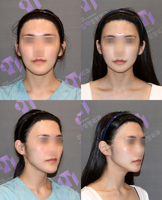 Which Surgery Do I Need: Contouring Surgery or Double-Jaw Surgery? image 20