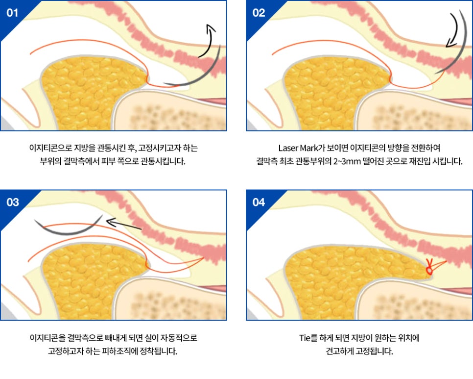 눈밑지방재배치와 하안검 수술이 어떻게 다른가요? 관련 이미지 5