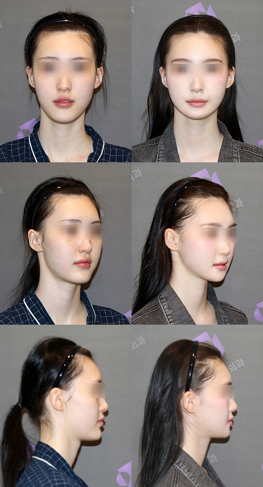 How Should Double Chin and Skin Sagging After Contouring Surgery Be Addressed? image 2