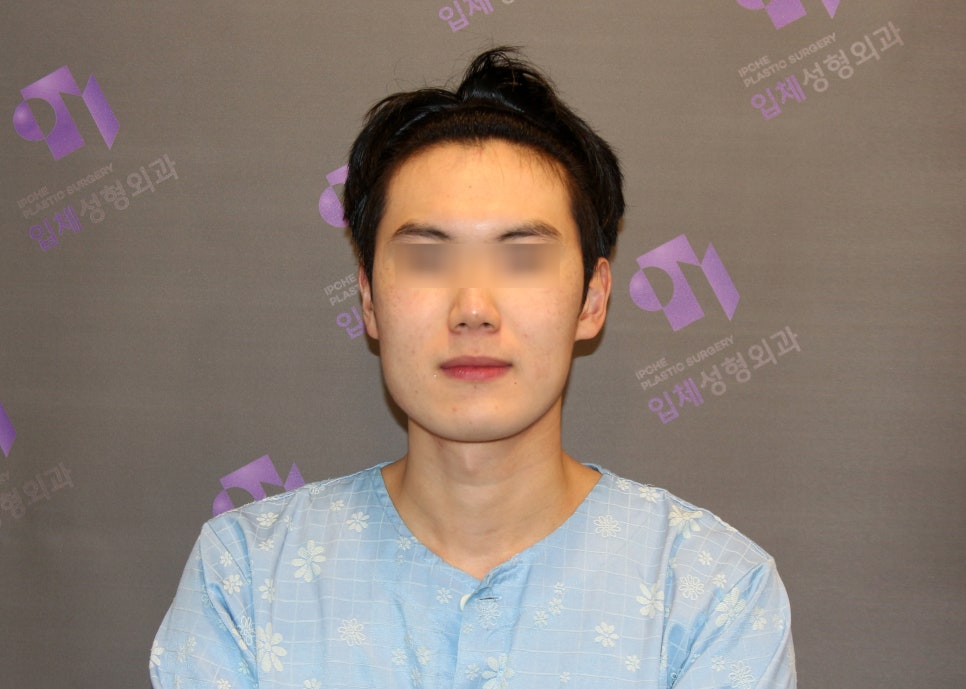 Male Facial Contouring (Zygoma Surgery, Square Jaw Surgery, Chin Surgery) - Explained by a Specialist. image 1
