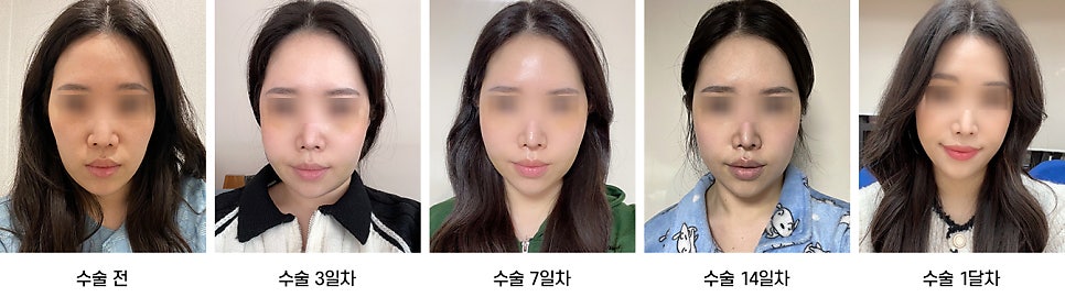 안면윤곽 수술 후 붓기, 일상생활은 언제부터 가능한가요? 케이스별로 알아보기 관련 이미지 1
