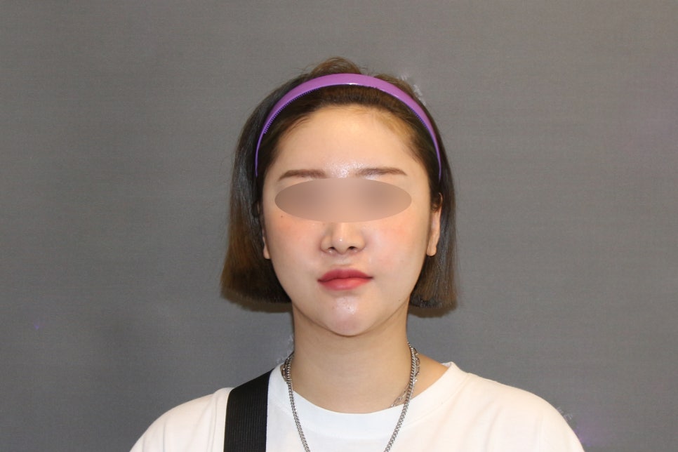 Facial Contouring Swelling, When Can I Go Back to Work? - A Specialist Explains Directly [입체성형외과] image 4