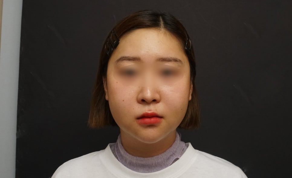 Facial Contouring Swelling, When Can I Go Back to Work? - A Specialist Explains Directly [입체성형외과] image 1