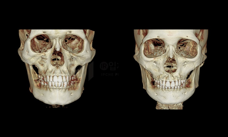 남자광대축소술이 여자와 다른 이유는? 관련 이미지 1