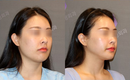 If There Is No Jaw Angle Below the Ear, Is It a Dog Jaw? What Is a Dog Jaw? image 6
