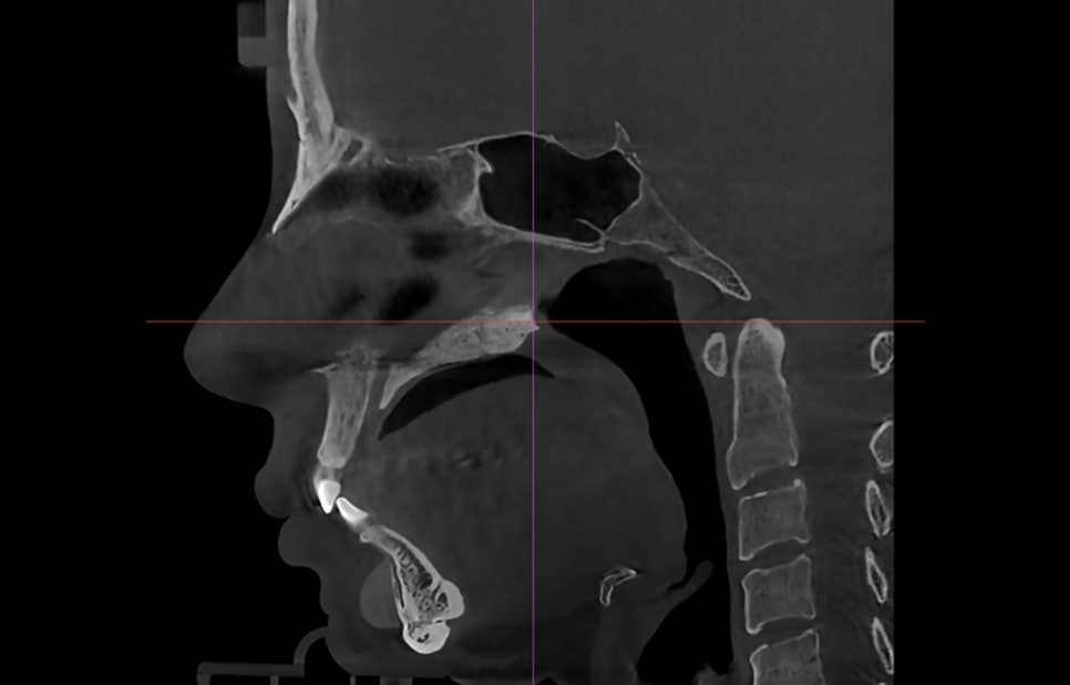 What Surgery Is Best for Correcting a Short Chin or Recessed Chin? The Limits of Chin Surgery and the Actual Results image 6