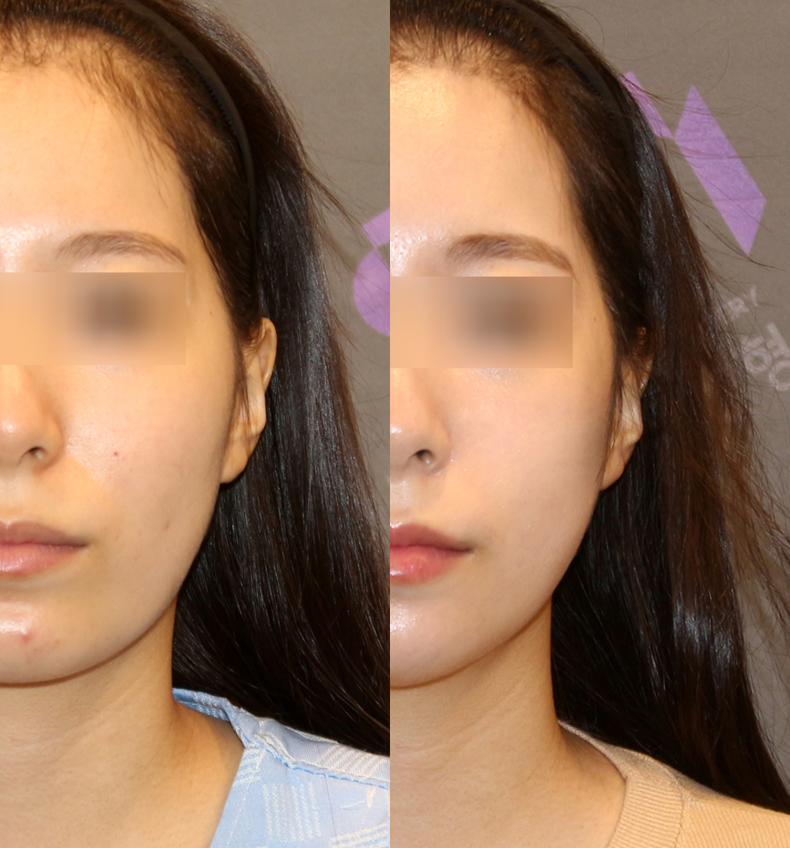 안면윤곽 연예인 고윤정, 카리나 얼굴형처럼 예뻐질 수 있을까요? 관련 이미지 5