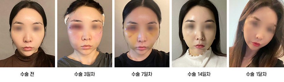 안면윤곽 수술 후 붓기, 일상생활은 언제부터 가능한가요? 케이스별로 알아보기 관련 이미지 3