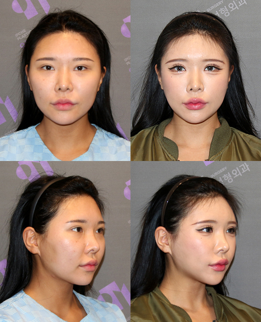 광대뼈 쉐이빙(갈아내기)을 하면 정말 볼처짐이 올까요? 관련 이미지 4
