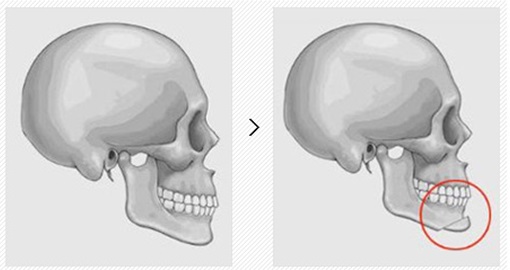 [Chin Correction Surgery] Implants and Genioplasty: Real Patient Cases and How They Work image 5