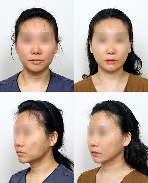 사각턱 수술했는데 왜 다시 해야 할까? 재수술이 필요한 이유 관련 이미지 1