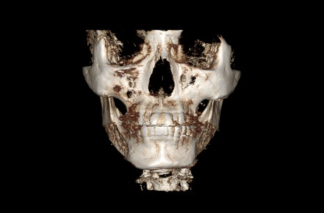 Are There People Who Can’t Have Cortical Ostectomy Surgery for a Frontal Square Jaw Effect? image 11