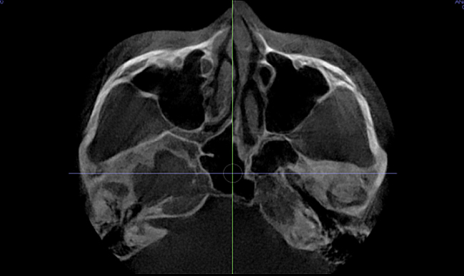 Will cheekbone reduction surgery also make the face smaller? : Learn about how to reduce prominent cheekbones with real surgical cases image 13