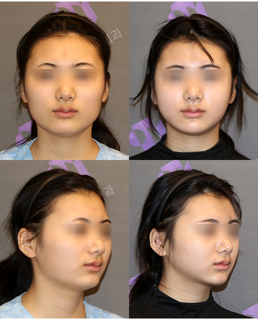 안면윤곽수술 후 붓기, 일차별(1일~30일차)사진과 함께 회복기간 알아보기 관련 이미지 6