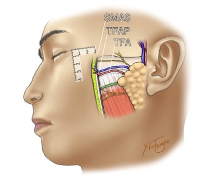 How effective is the incision method compared to the non-incision method for cheek hollow correction? image 8