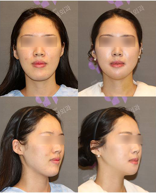 안면윤곽성형외과 실패하는 사람들의 공통점 관련 이미지 1