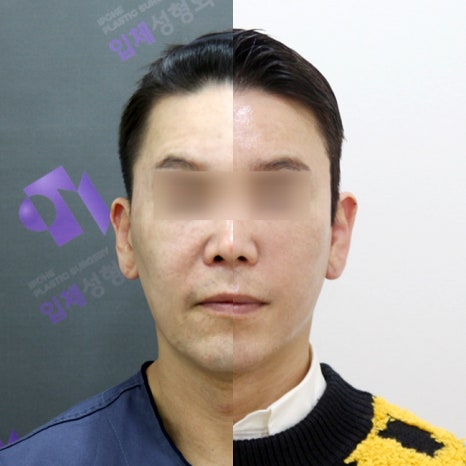 When Are Facial Contouring Surgery and Facelift Surgery Needed Together? image 2