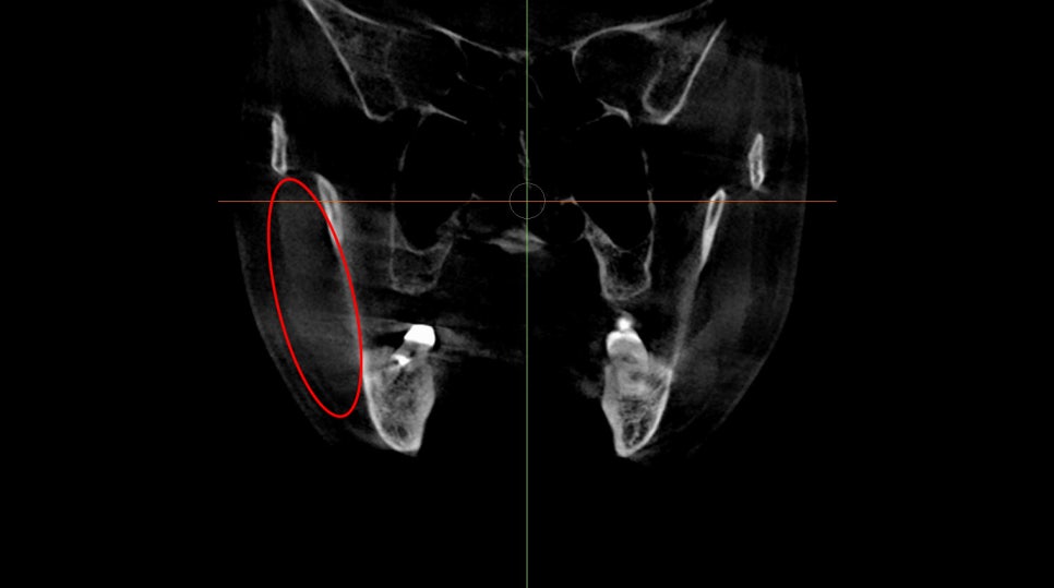About Masseter Reduction Surgery for Improving the Frontal Effect of the Lower Face image 1
