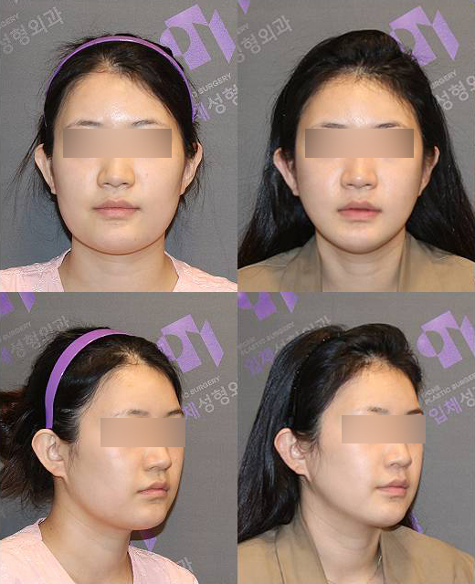 사각턱축소술, 입안절개 사각턱수술과 귀뒤 사각턱의 차이와 CT분석 관련 이미지 6