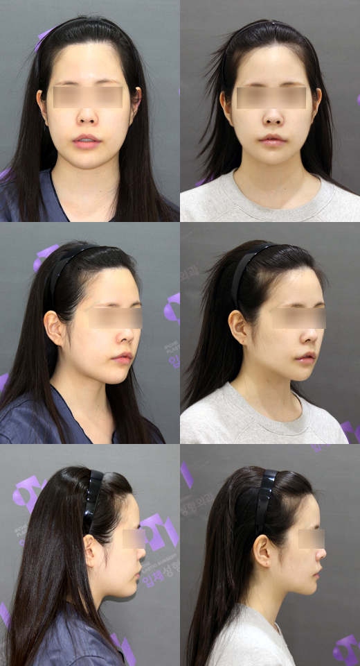 Let's Take a Close Look at Double Chin Removal and Double Chin Muscle Tightening. image 4