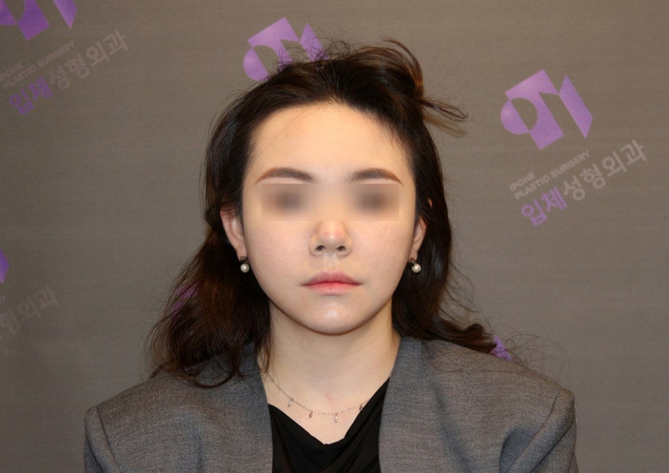 윤곽수술과 같이 하면 좋은 수술 : 귀족수술 관련 이미지 4