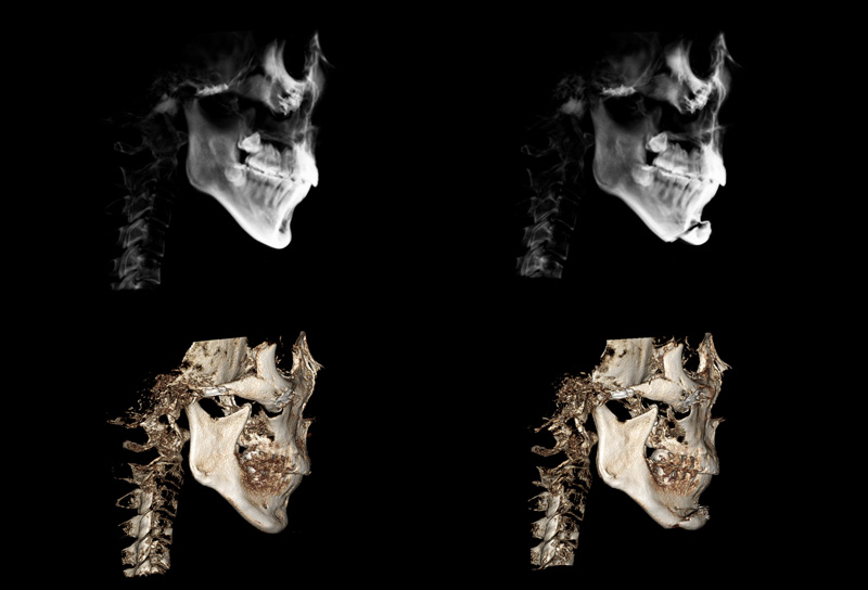 What Surgery Is Needed for a Long, Recessed Chin or a Short, Recessed Chin? image 3