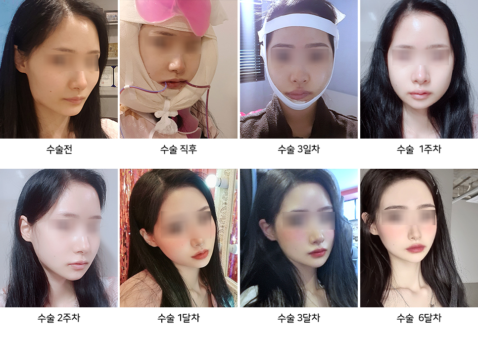 안면윤곽수술 후 피주머니 피통 꼭 착용해야 하나요? 관련 이미지 4