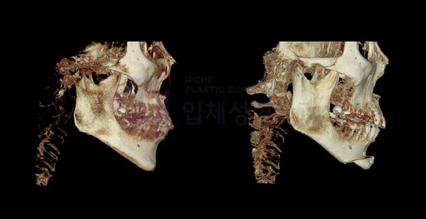 Can Chin Advancement Surgery Adjust Chin Length? image 9
