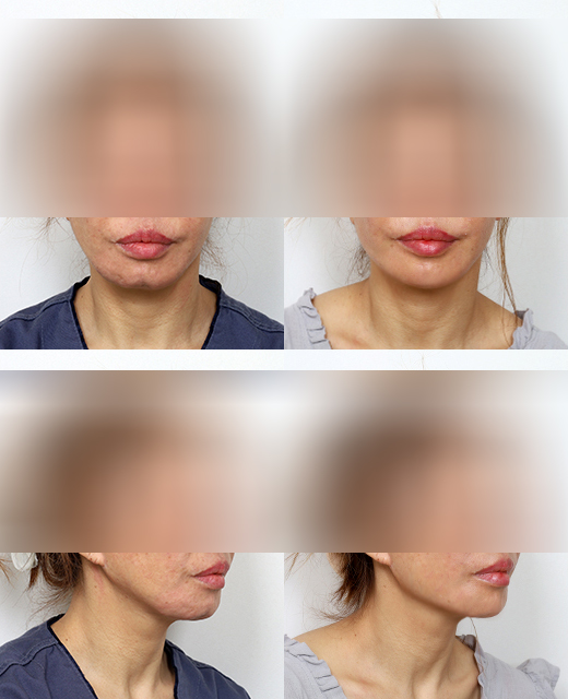 사각턱 수술했는데 왜 다시 해야 할까? 재수술이 필요한 이유 관련 이미지 8