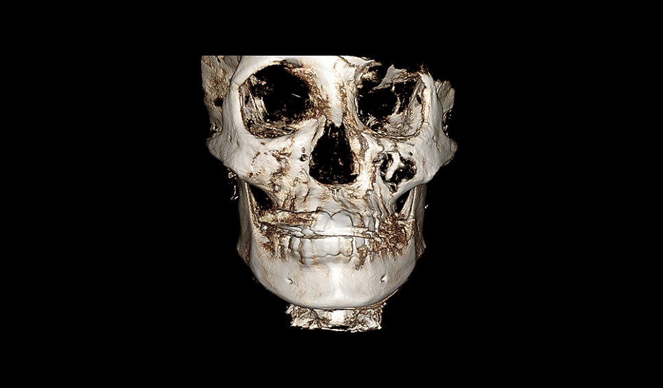 Why Is Male Cheekbone Reduction Different from Female Cheekbone Reduction? image 2