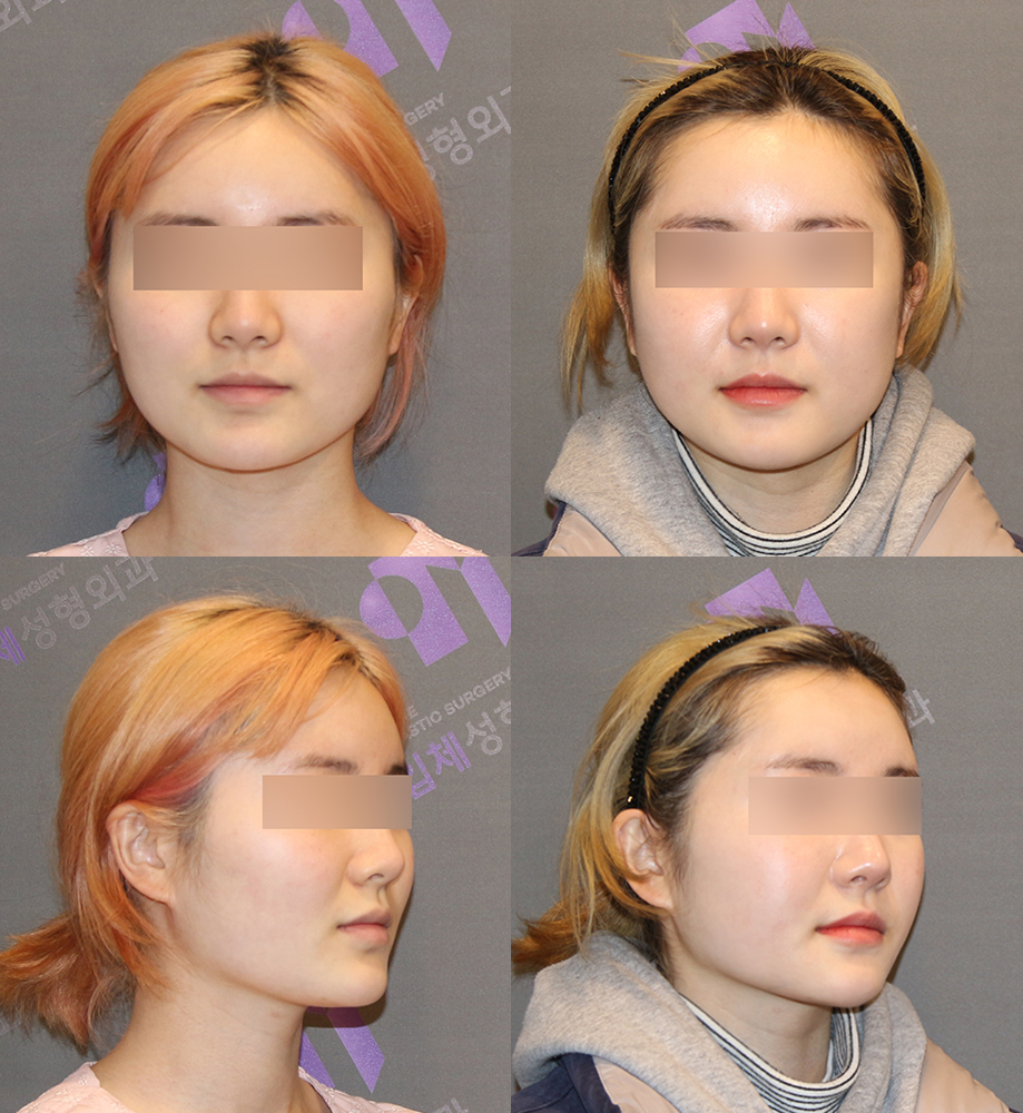 Is General Anesthesia Absolutely Necessary for Cheekbone Surgery in Facial Contouring? - Explained by a Board-Certified Plastic Surgeon image 1
