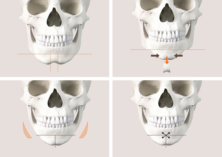 [Chin Surgery] Learning About Contouring Shaving and T-Osteotomy with Real Patient Cases (3) image 1