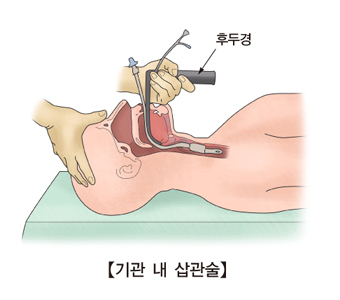 윤곽수술 후 기침과 피가래, 왜 생기고 언제까지 지속될까요? 관련 이미지 1