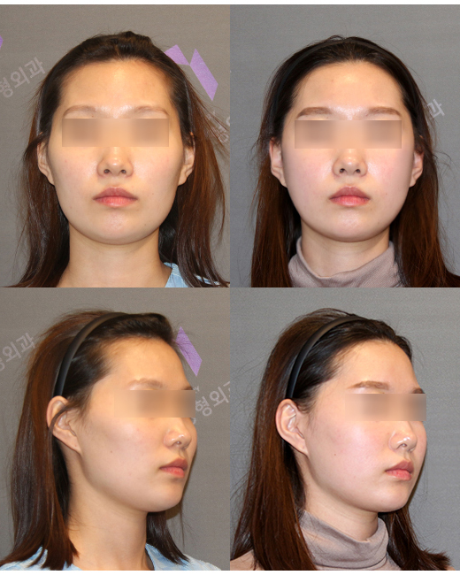 광대수술 후 이차각, 계단현상은 왜 생기는 걸까요? 관련 이미지 9