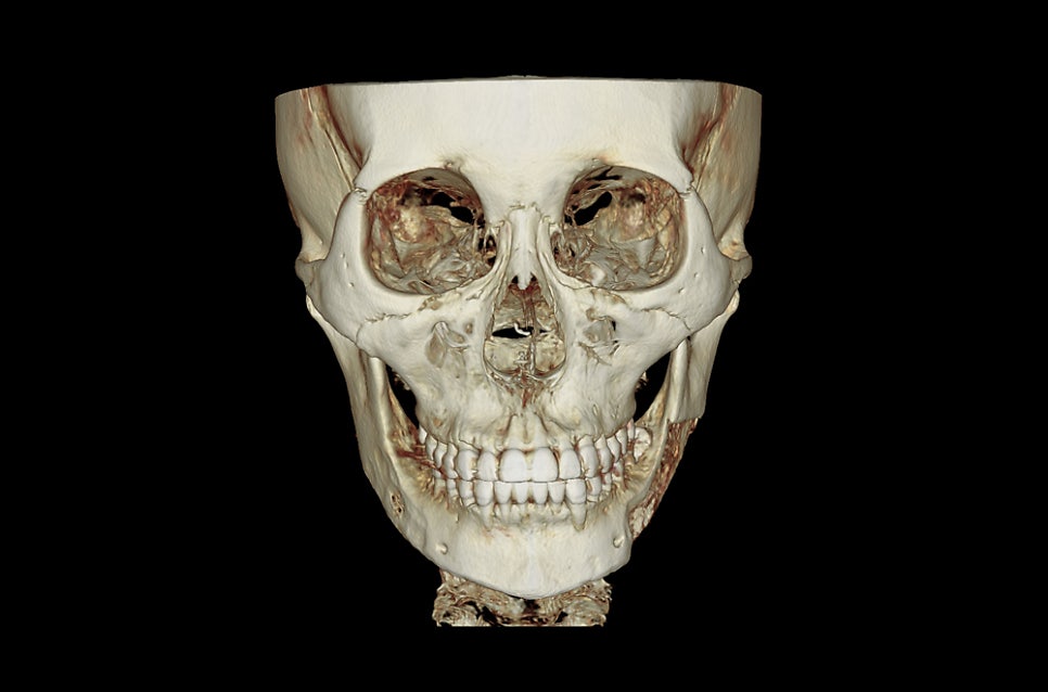 Square Jaw Surgery: The Difference Between Cortical Osteotomy and Lateral Cortical Shaving image 9