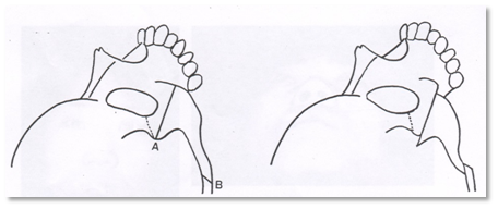 Why Are There So Many Methods for Cheekbone Surgery? A Look at Osteotomy Methods image 6
