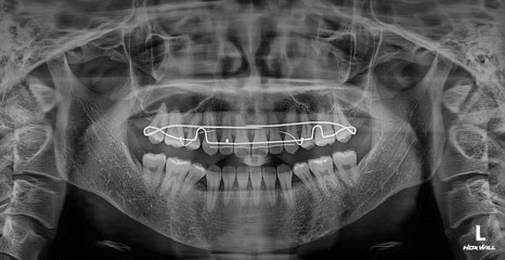 Long Midface and Lower Face Long-Face, Long-Chin Surgery - Cases That Do Not Require Double-Jaw Surgery image 14