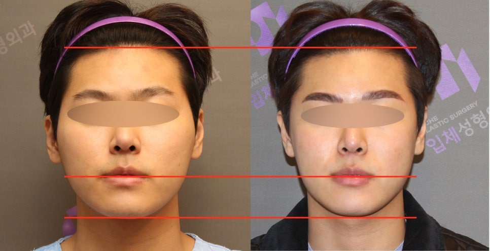 Male Cheekbone Reduction Surgery, Explained with Before-and-After Photos of Facial Contouring Surgery. image 5